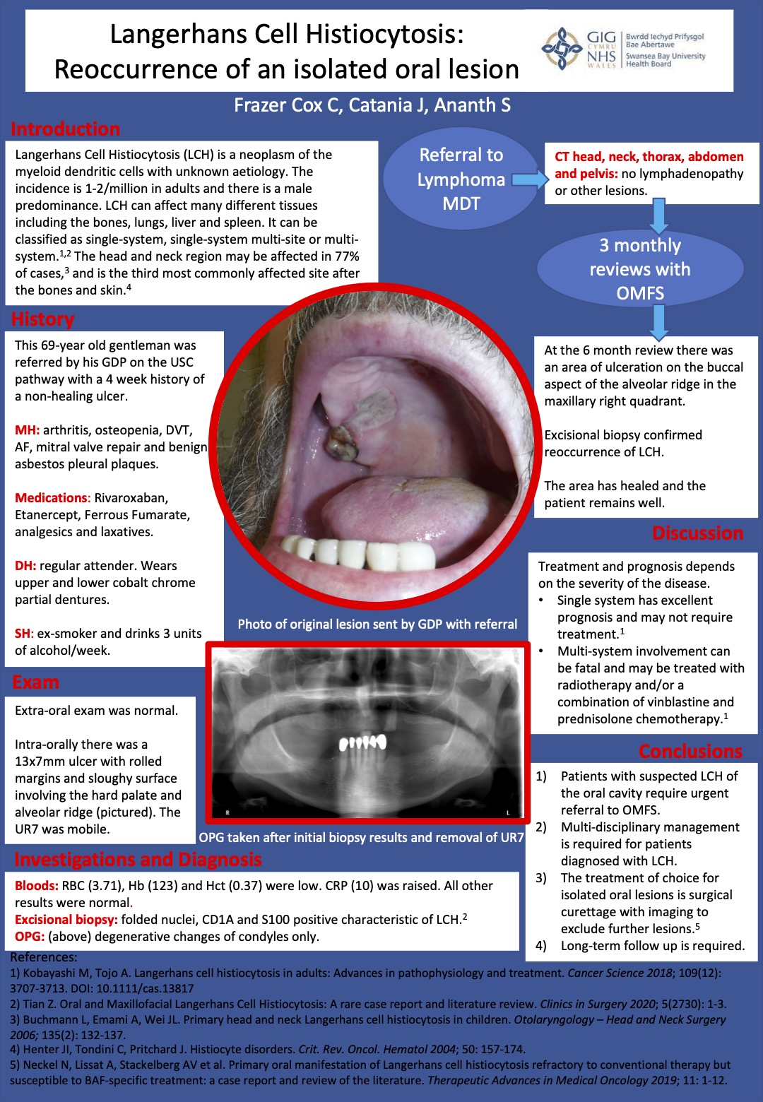 Poster Langerhans Cell Histiocytosis: Recurrence of an isolated oral lesion